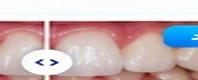 قبل العلاج