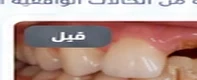 بعد العلاج