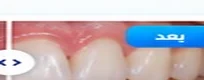 قبل العلاج