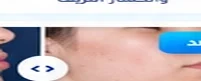 قبل العلاج
