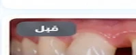 بعد العلاج