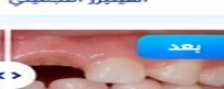 قبل العلاج