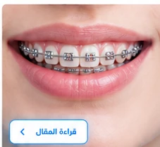 ابتسامة مع تقويم الأسنان