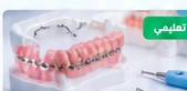 صورة مقال عن المثبت بعد التقويم: أهميته وأنواعه ومدة استخدامه